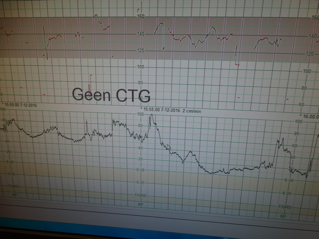 tweede bevalling